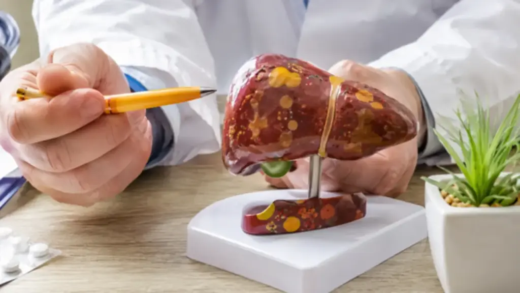 Vì sao bệnh gan nhiễm mỡ lại gia tăng ở những người không uống rượu?